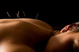 Picture of woman with acupuncture needle in back